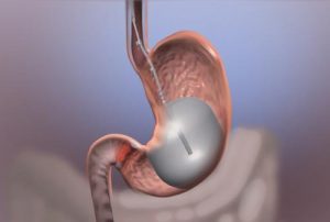 Gastrik Balon Nedir?